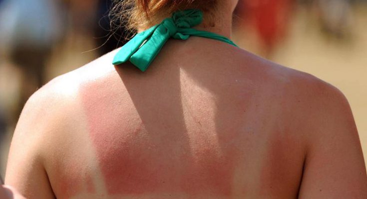 Обгорели на солнце — помогут народные средства